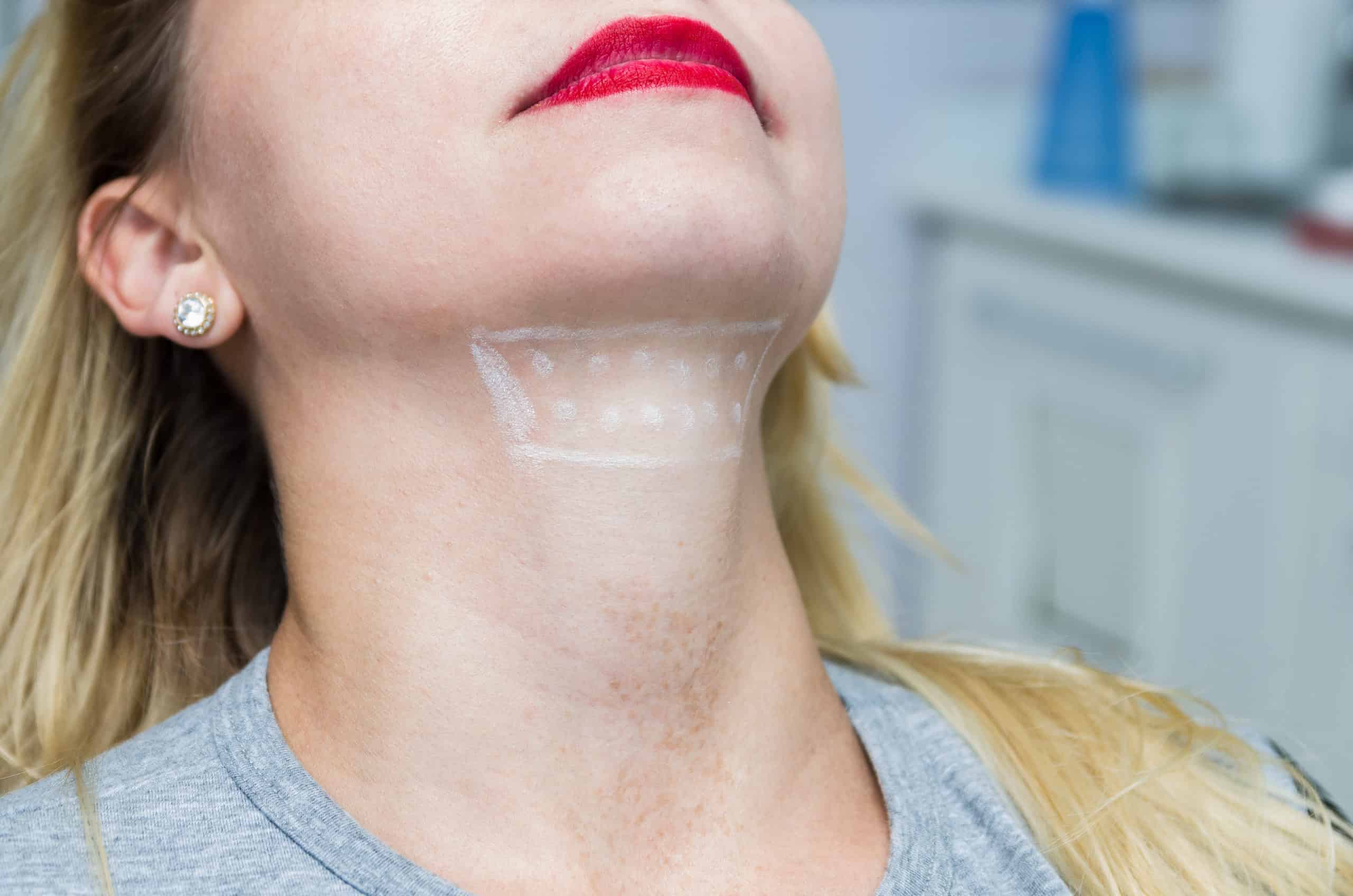 Which is the Best Fat Reduction treatment, Kybella or Coolsculpting