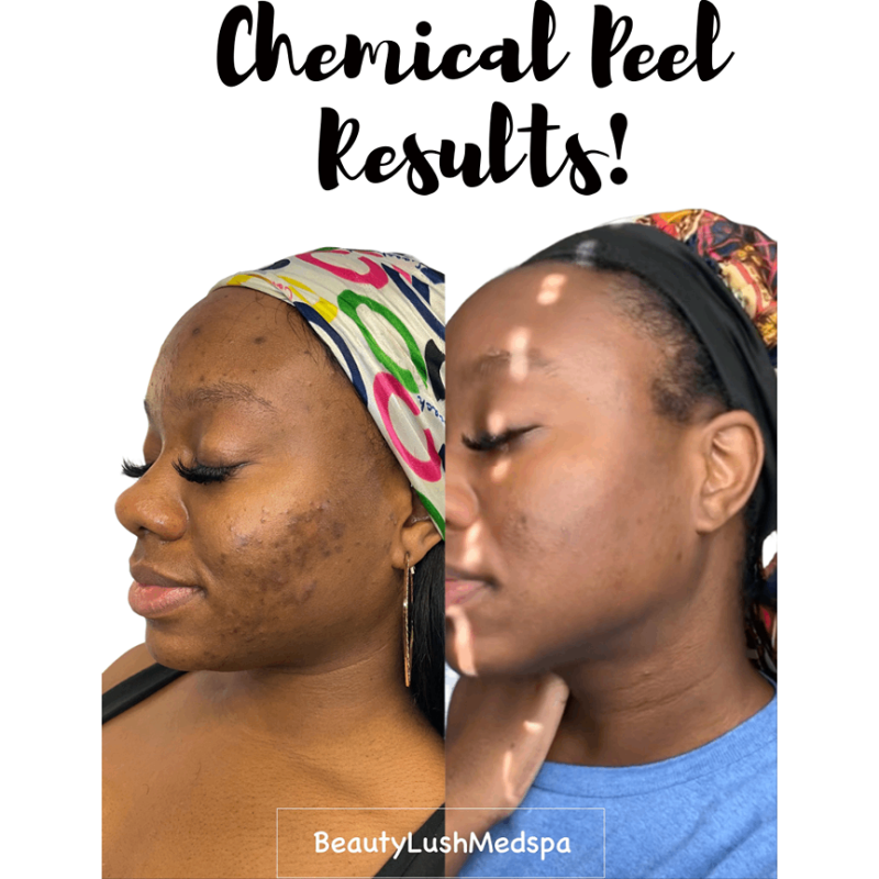 Acne Chemical Peel_before-after-image-beauty-lush-med-spa