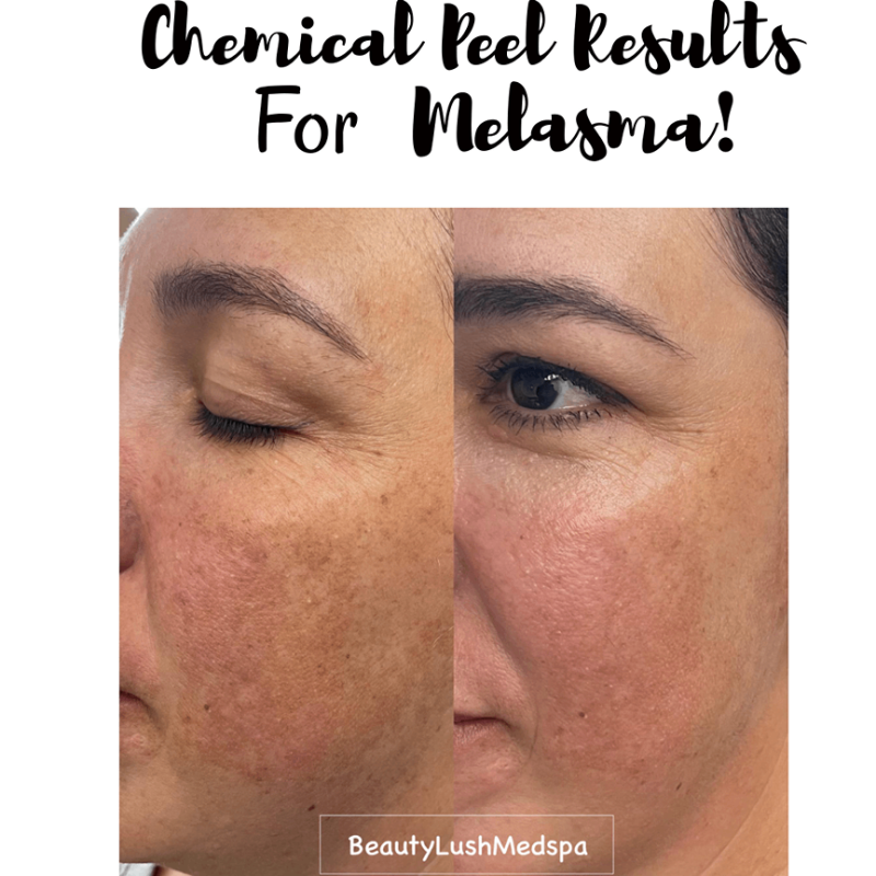 Chemical Peel Melasma_before-after-image-beauty-lush-med-spa