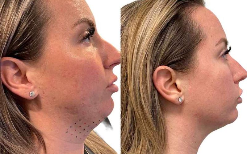 Double Chin Kybella